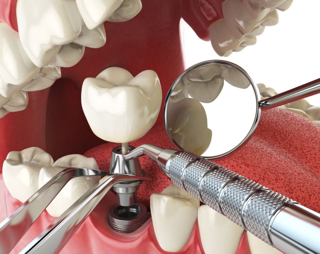 best implant dentist near me, dental implants near me