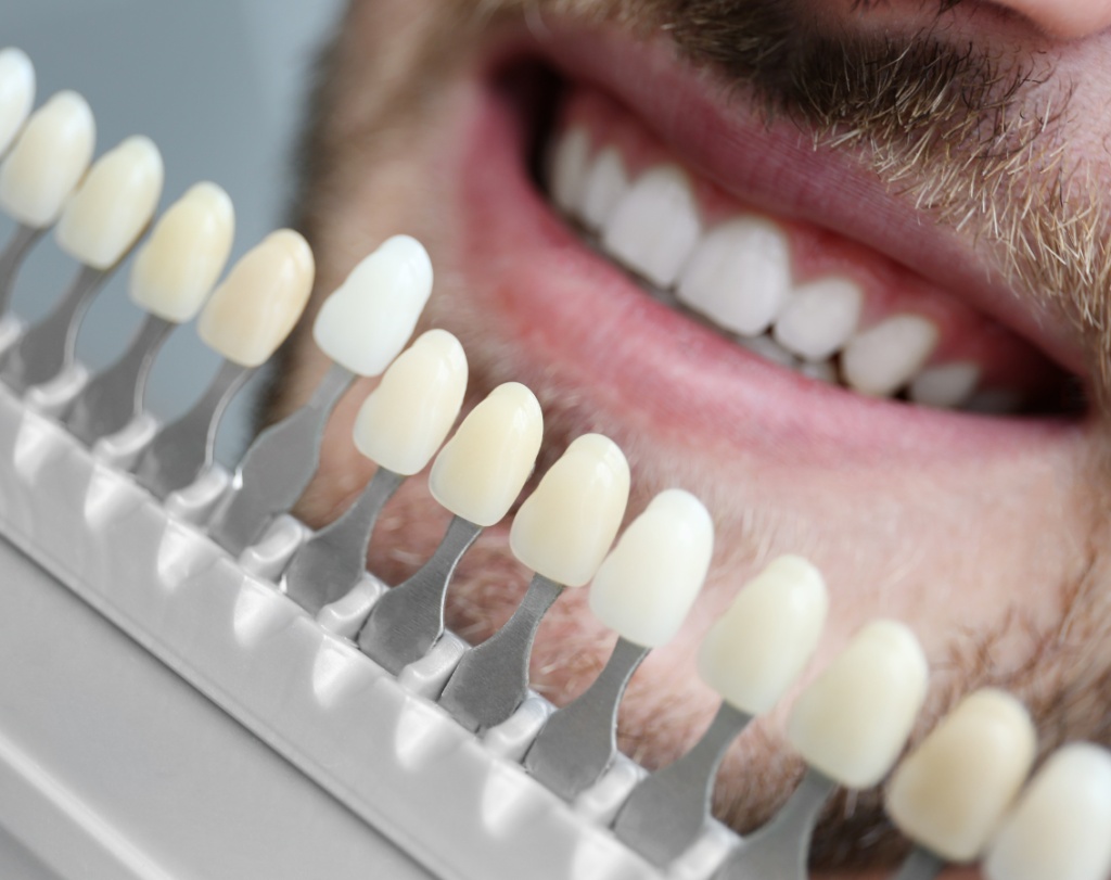 dental veneers​ near me