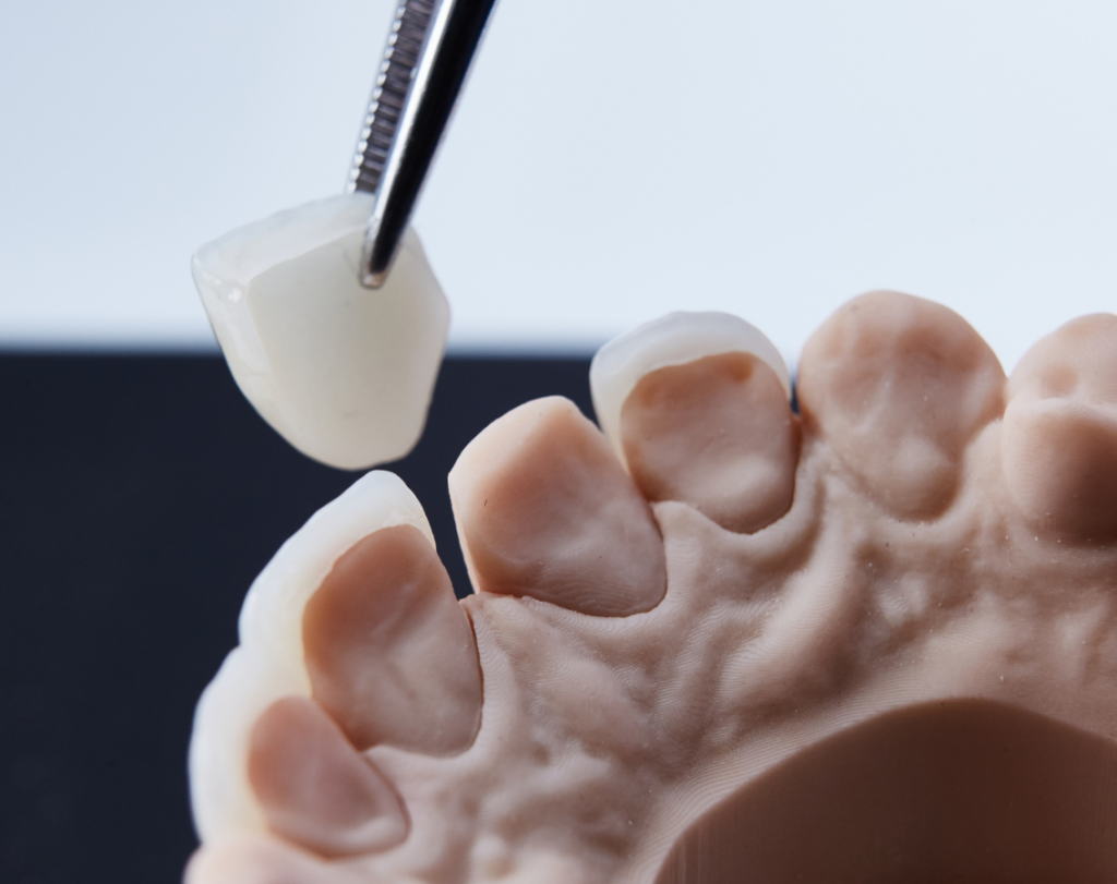 dental veneers​ in nashik