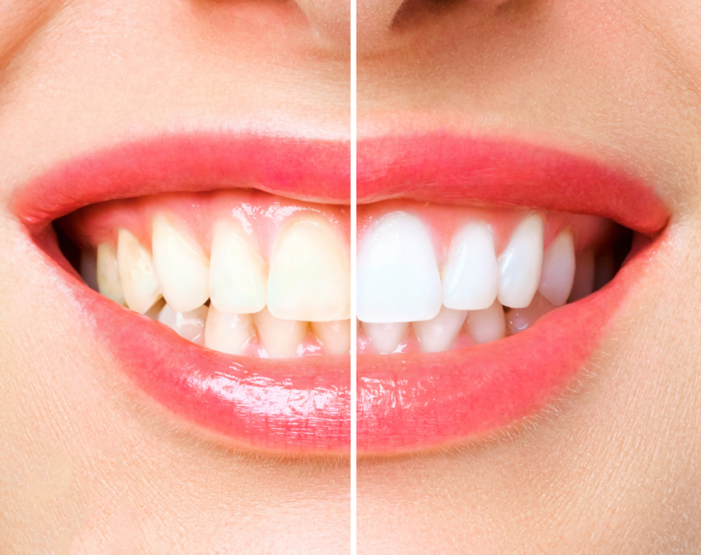 teeth doctor near me, teeth whitening near me