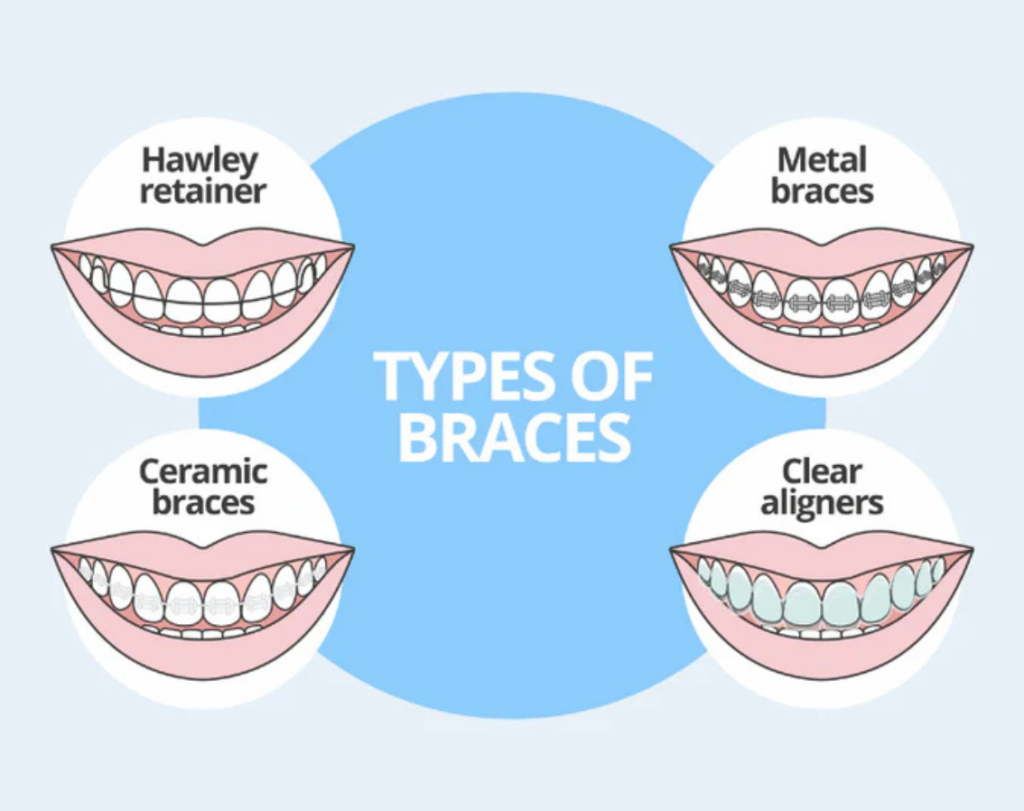 teeth braces cost in nashik, braces dentist near me,