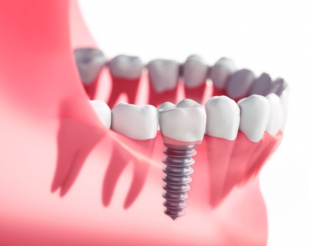 dental implant cost in nashik