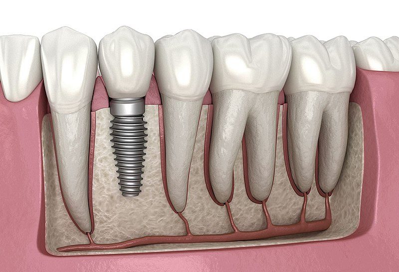 affordable dental implants in Nashik, affordable implants near me, affordable teeth implants , dental implants affordable near me,